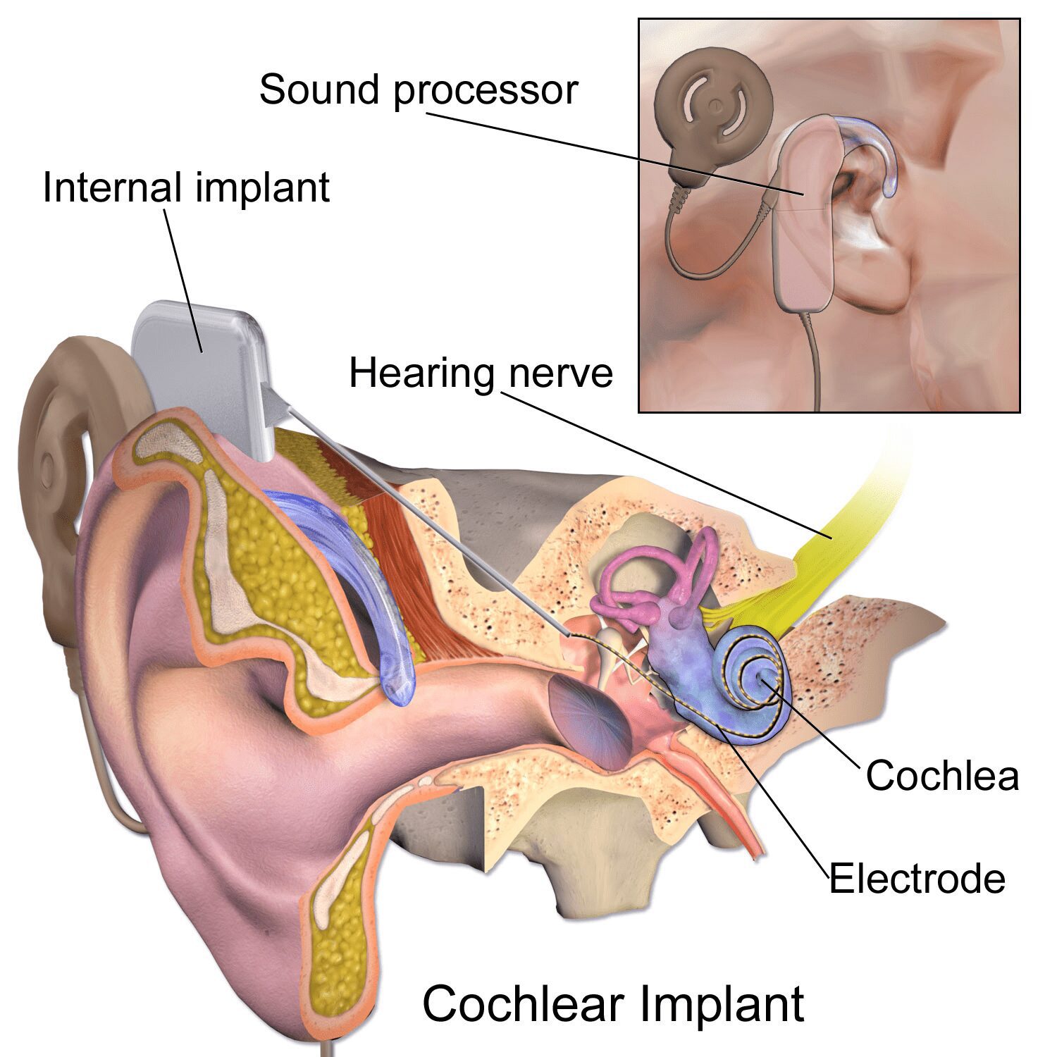 Tanzania: Aga Khan Hospital performs first electronic ear implant surgery 1 CochlearImplant 01